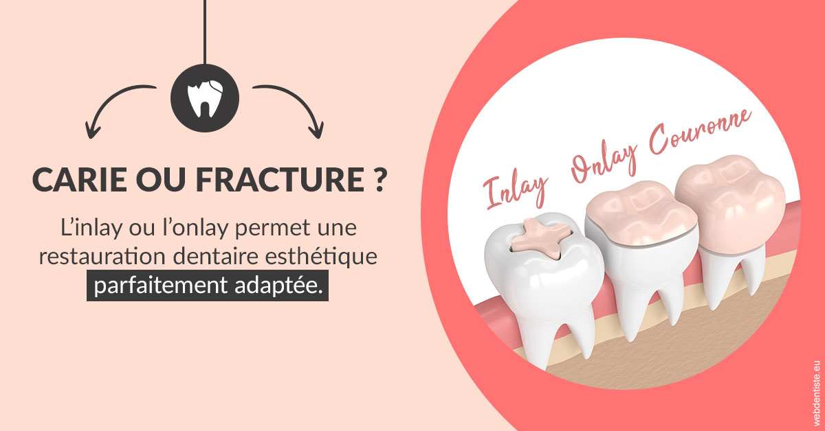 https://dr-romain-gueudin.chirurgiens-dentistes.fr/T2 2023 - Carie ou fracture 2