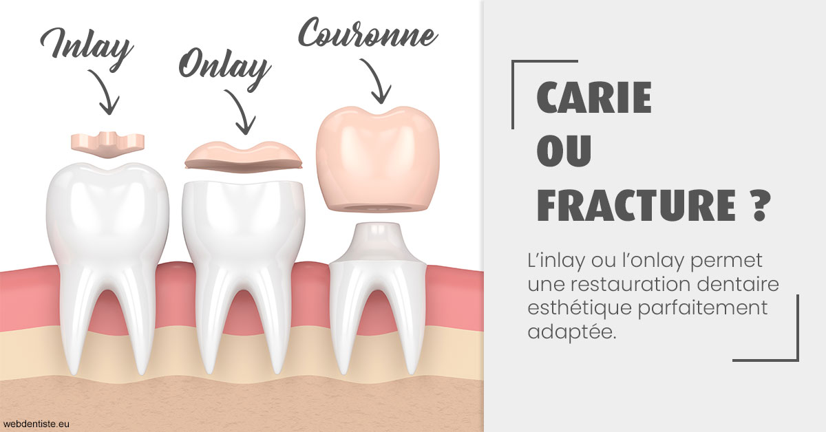 https://dr-romain-gueudin.chirurgiens-dentistes.fr/T2 2023 - Carie ou fracture 1