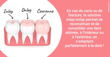 https://dr-romain-gueudin.chirurgiens-dentistes.fr/L'INLAY ou l'ONLAY 2