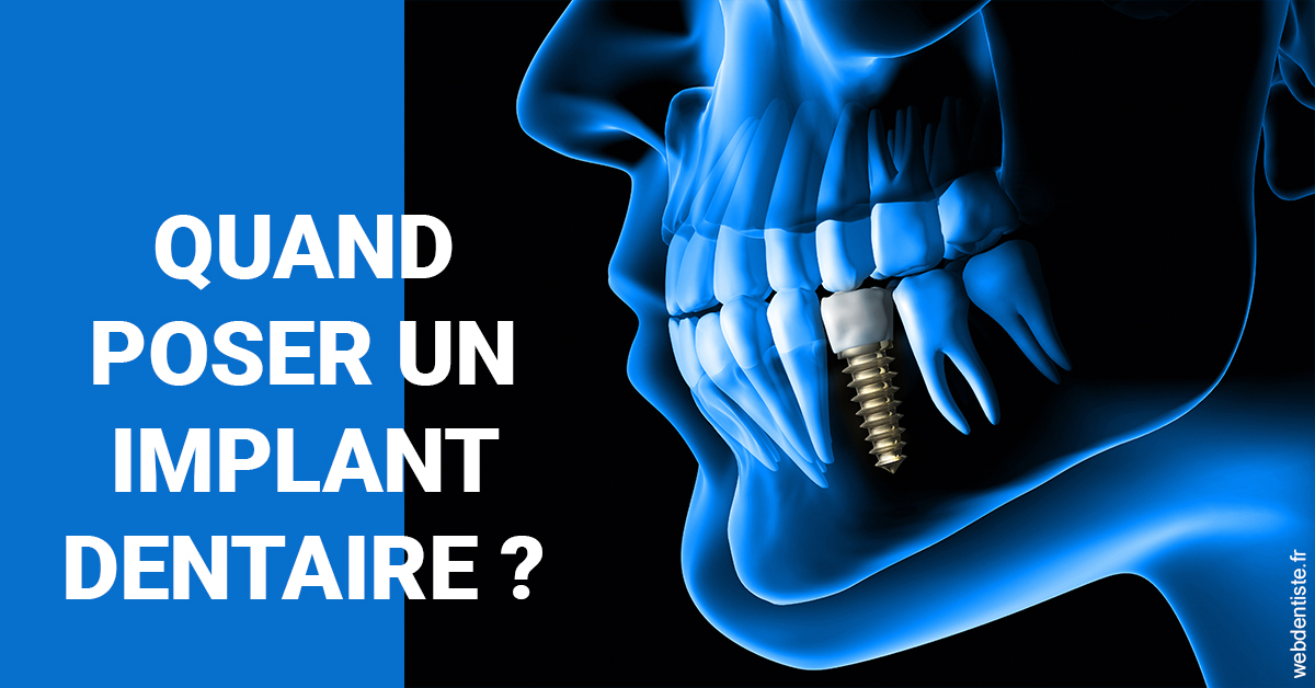https://dr-romain-gueudin.chirurgiens-dentistes.fr/Les implants 1
