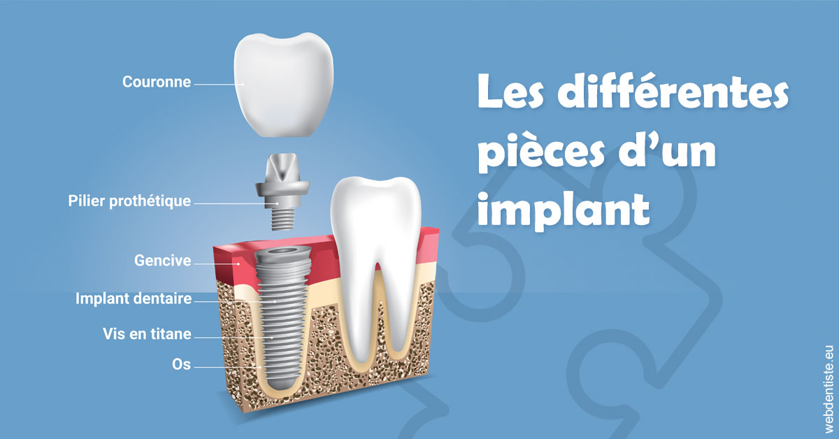 https://dr-romain-gueudin.chirurgiens-dentistes.fr/Les différentes pièces d’un implant 1